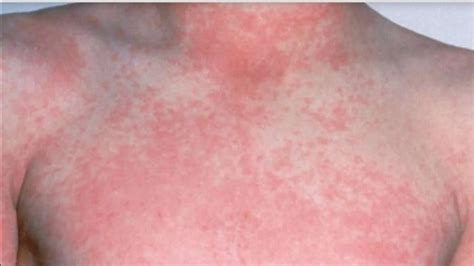 sintomas de escarlatina - picada de mosquito inflamada